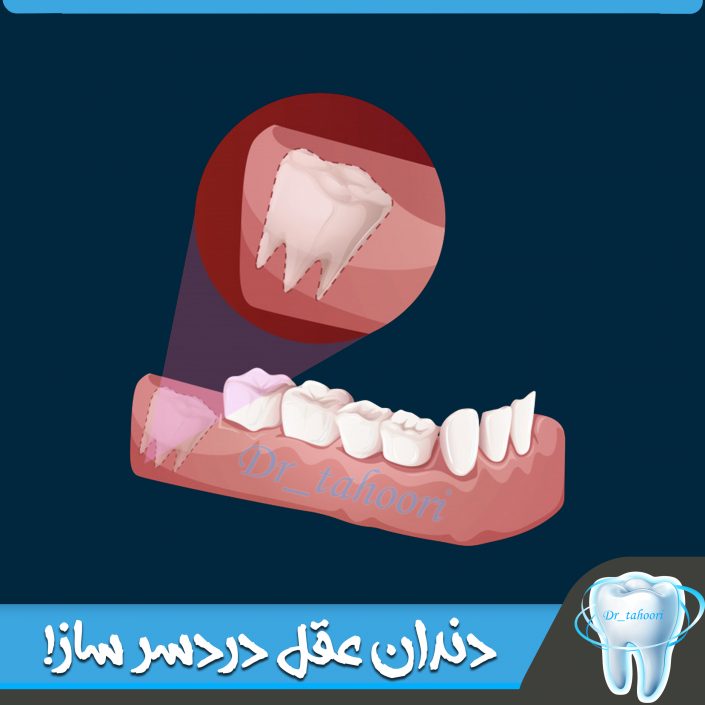 جراحی دندان عقل جراحی دندان عقل