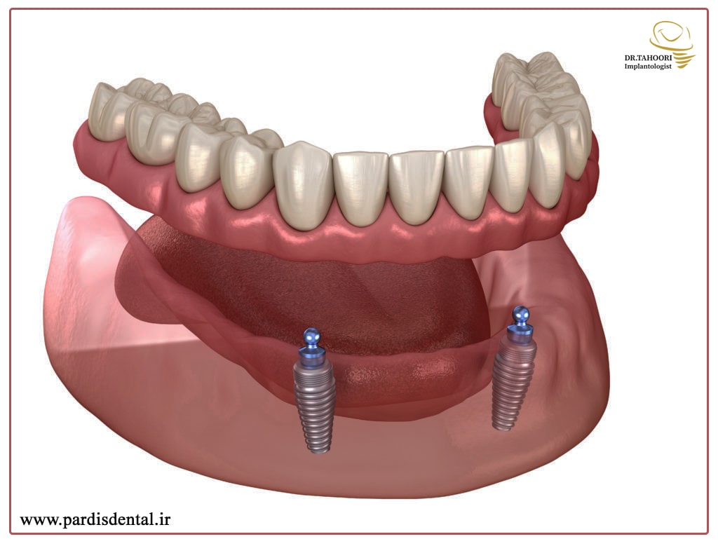 قیمت دندان مصنوعی با پایه ایمپلنت