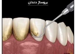 بروساژ دندان