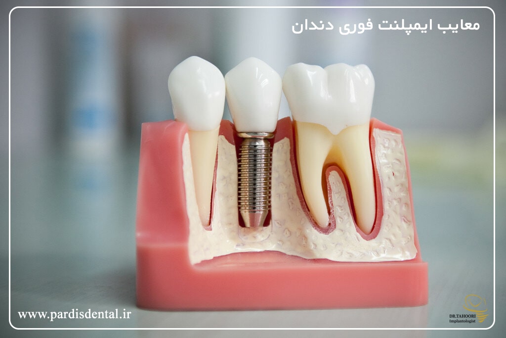 معایب ایمپلنت فوری دندان
