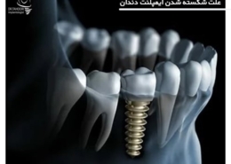 علت شکستن ایمپلنت دندان