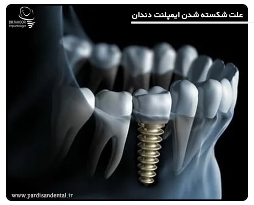 علت شکستن ایمپلنت دندان