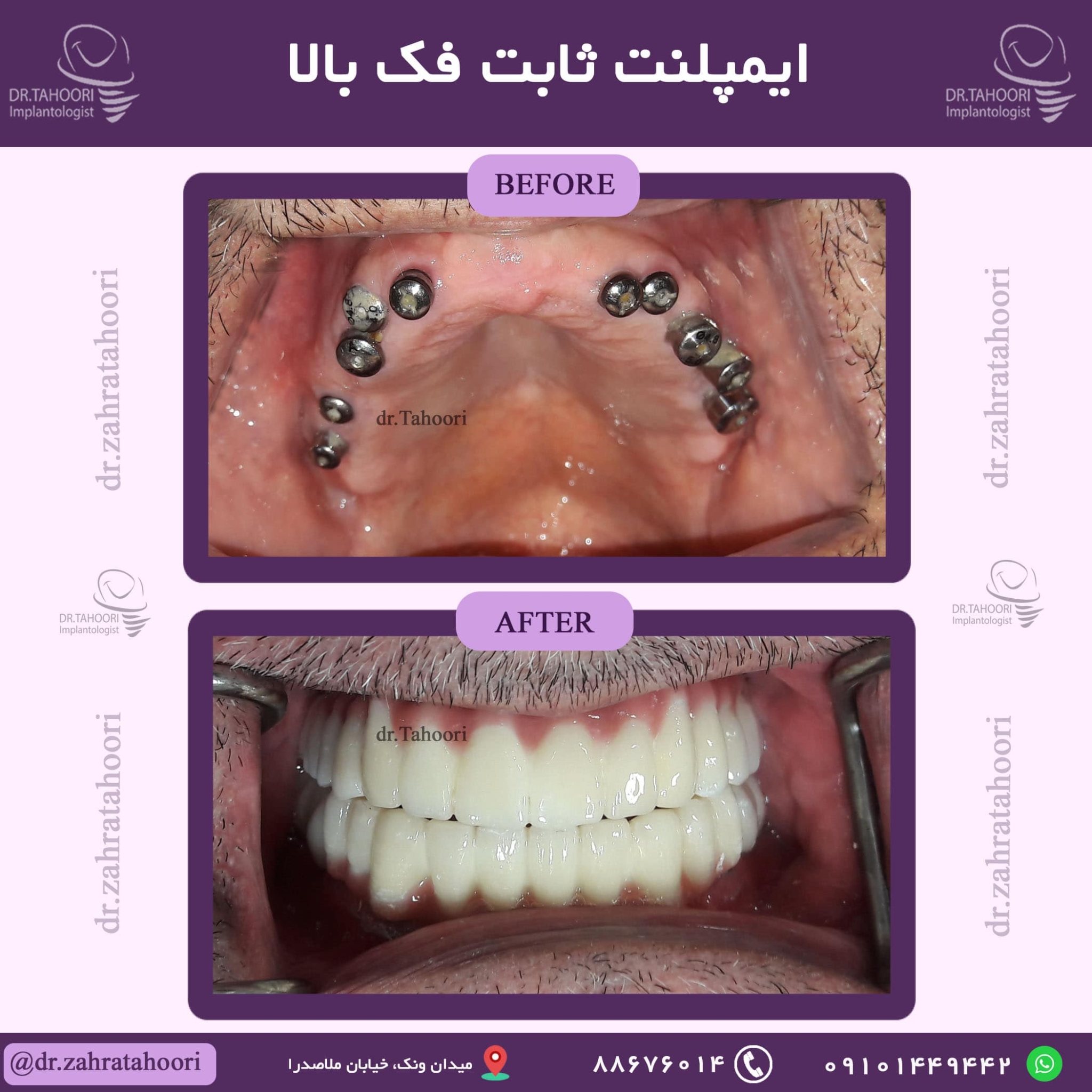 ایمپلنت ثابت فک بالا