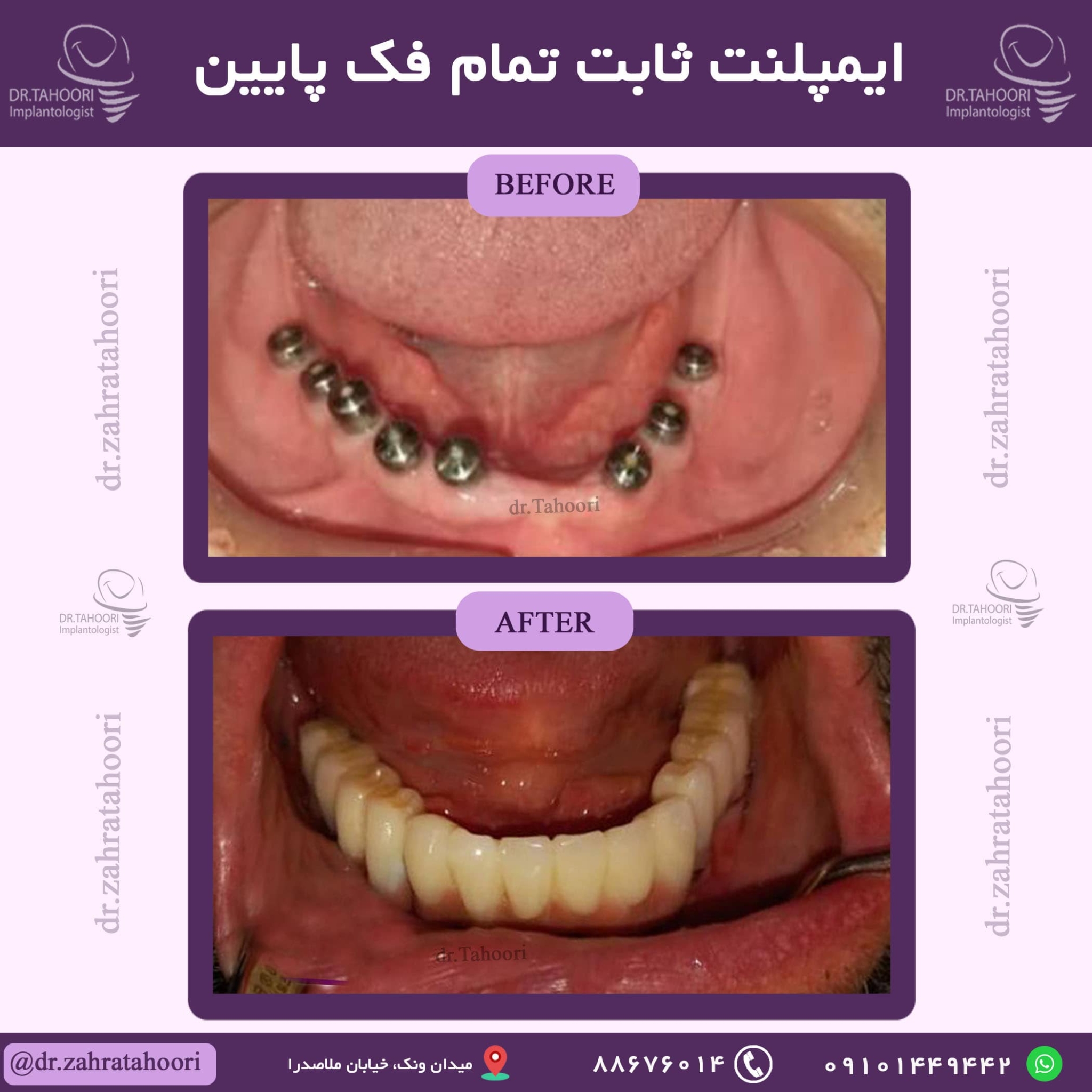 ایمپلنت ثابت تمام فک پایین