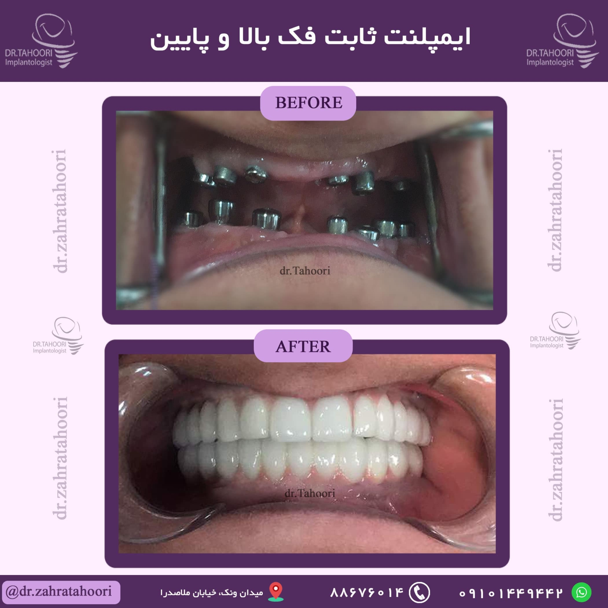 ایمپلنت ثابت فک بالا و پایین