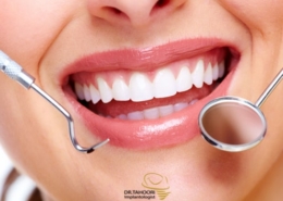مراحل کامپوزیت دندان