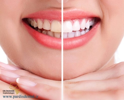 مراحل بلیچینگ دندان