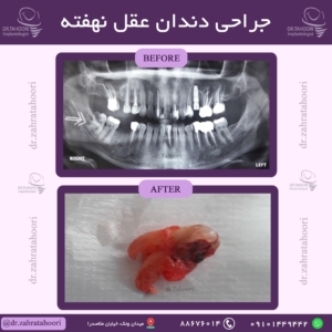 نمونه جراحی دندان عقل