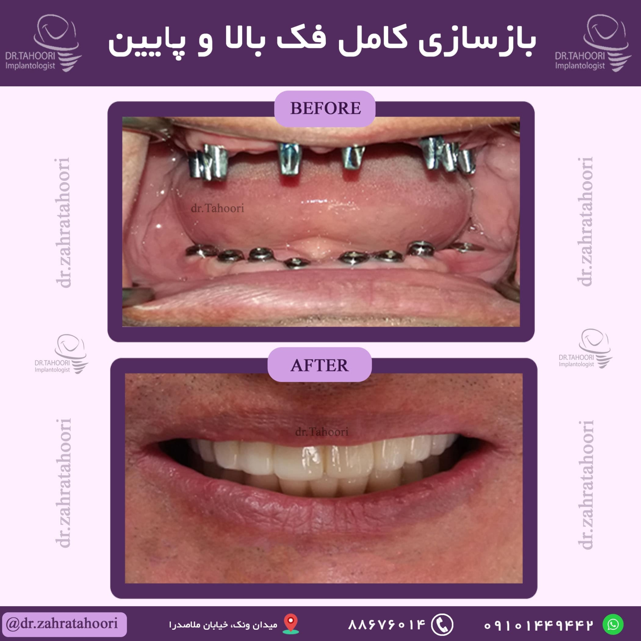 بازسازی کامل فک بالا و پایین