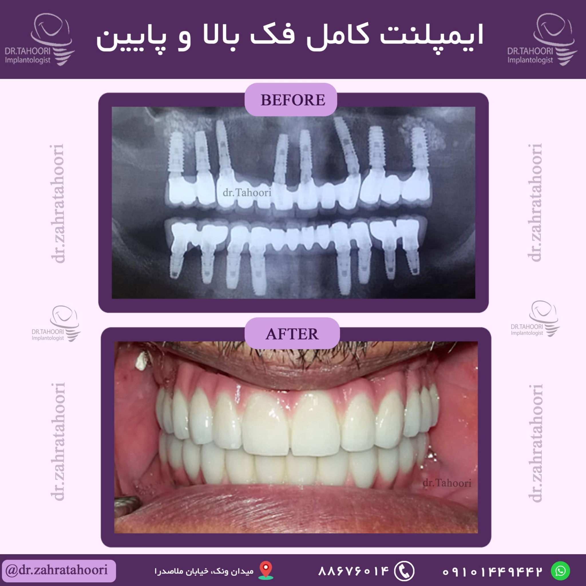 ایمپلنت کامل فک بالا و پایین