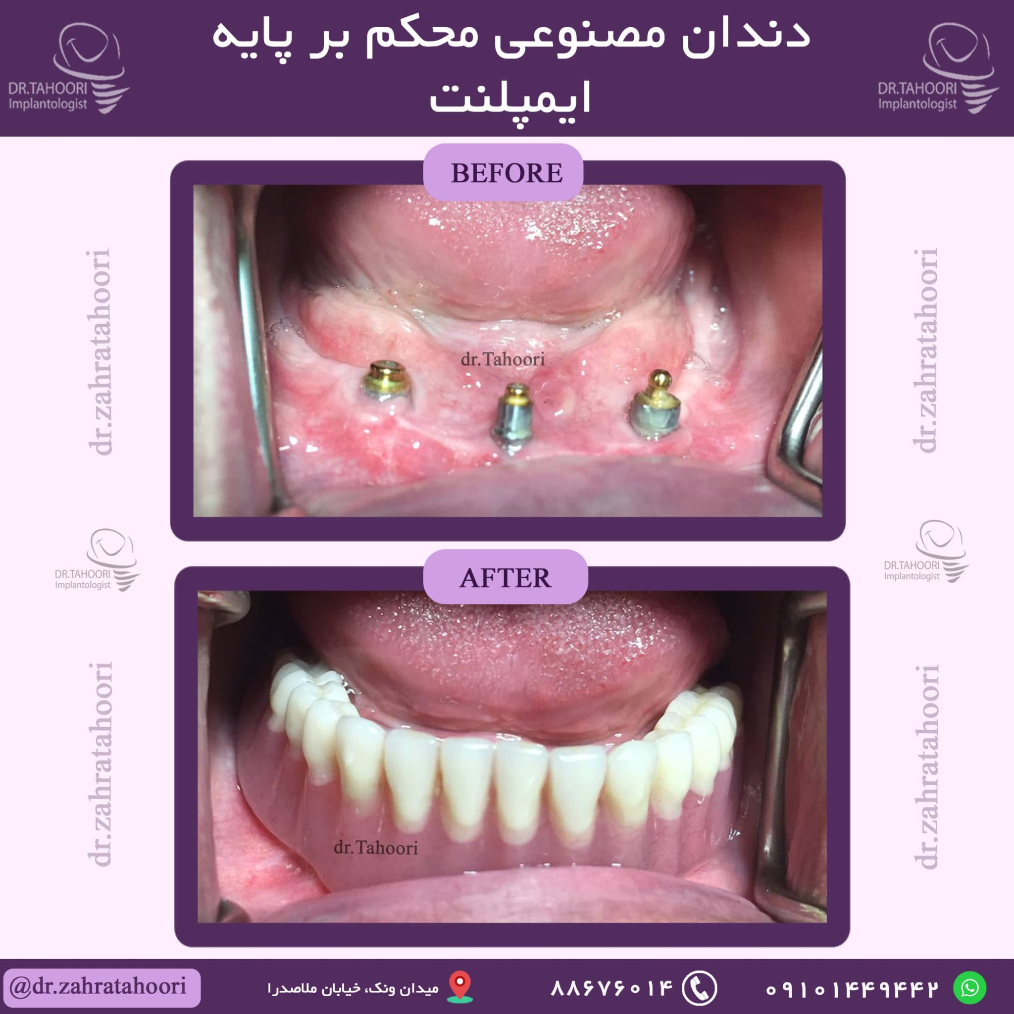 عکس دندان مصنوعی بر پایه ایمپلنت