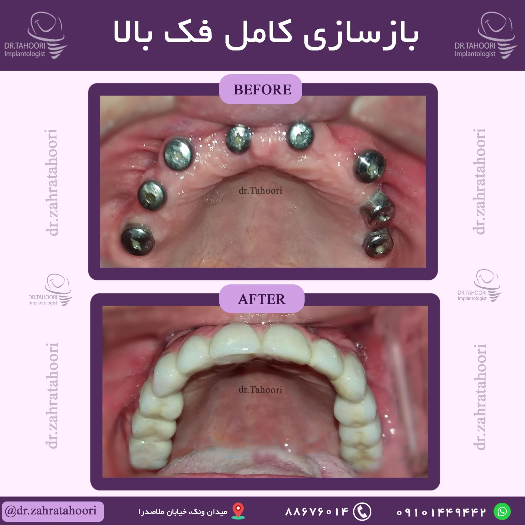 بازسازی کامل فک بالا