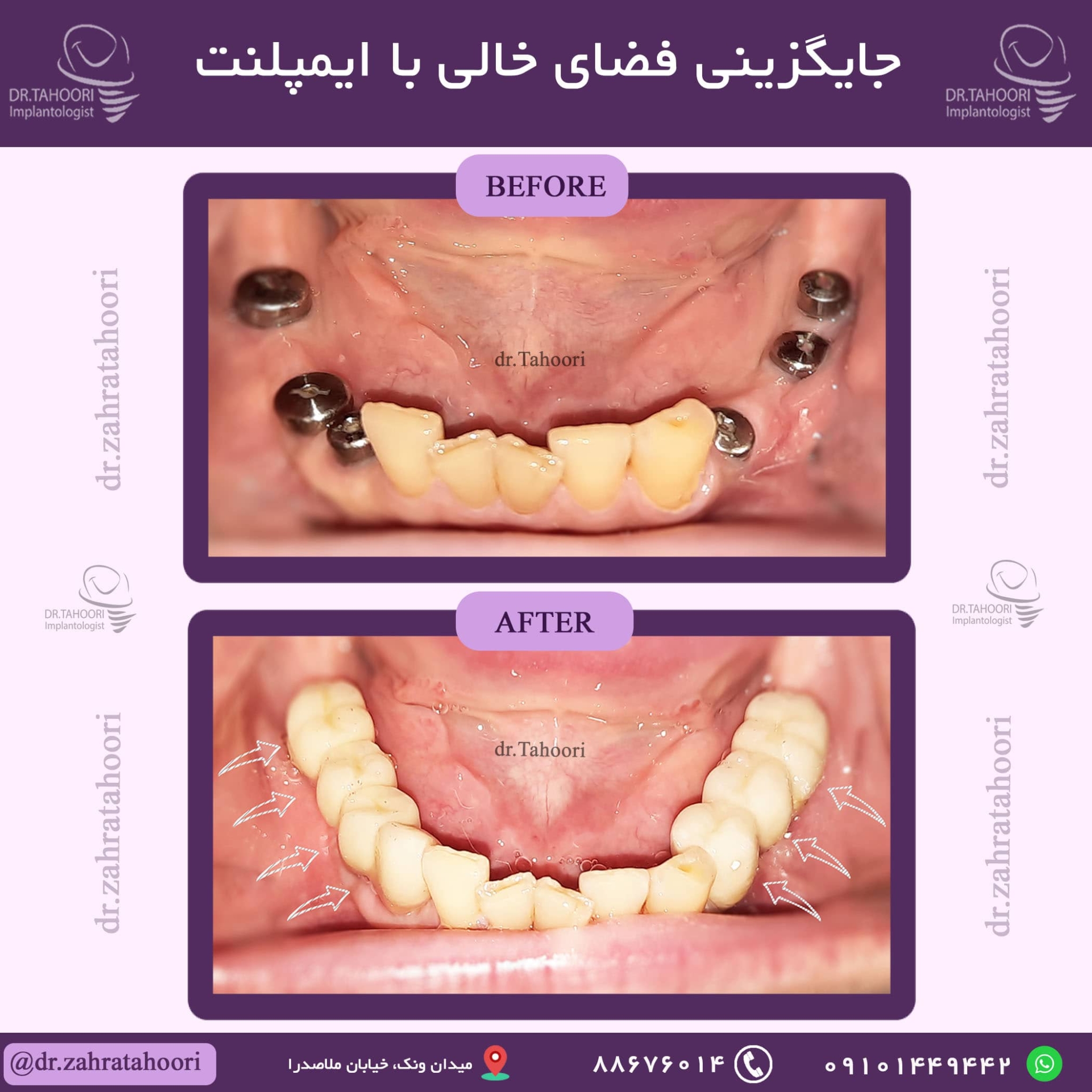 جایگزینی فضای خالی با ایمپلنت