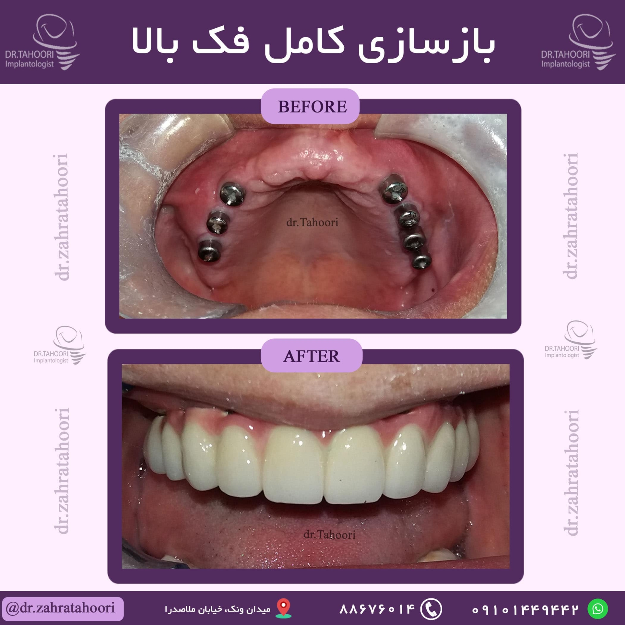 بازسازی کامل فک بالا