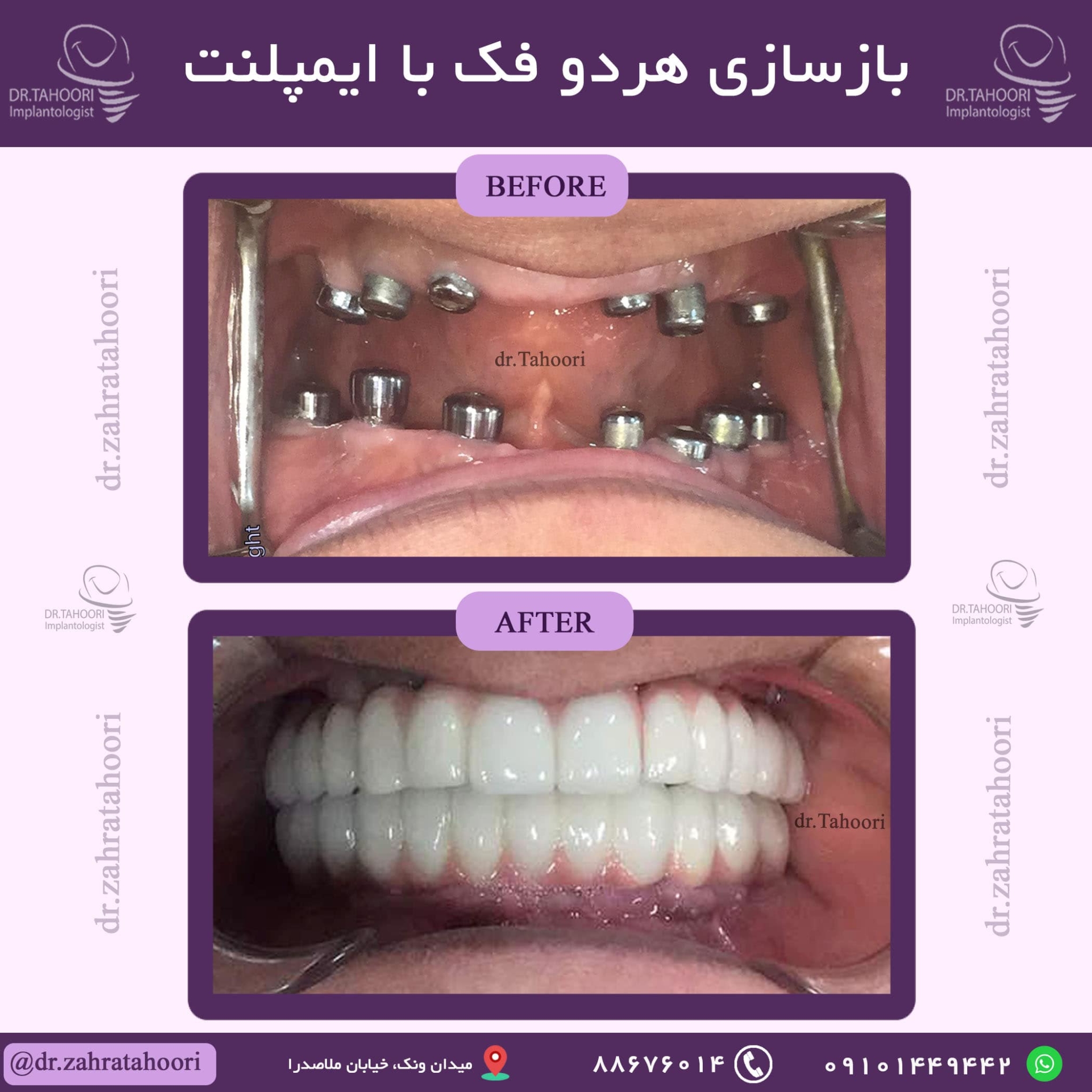 عکس بازسازی هر دو فک با ایمپلنت