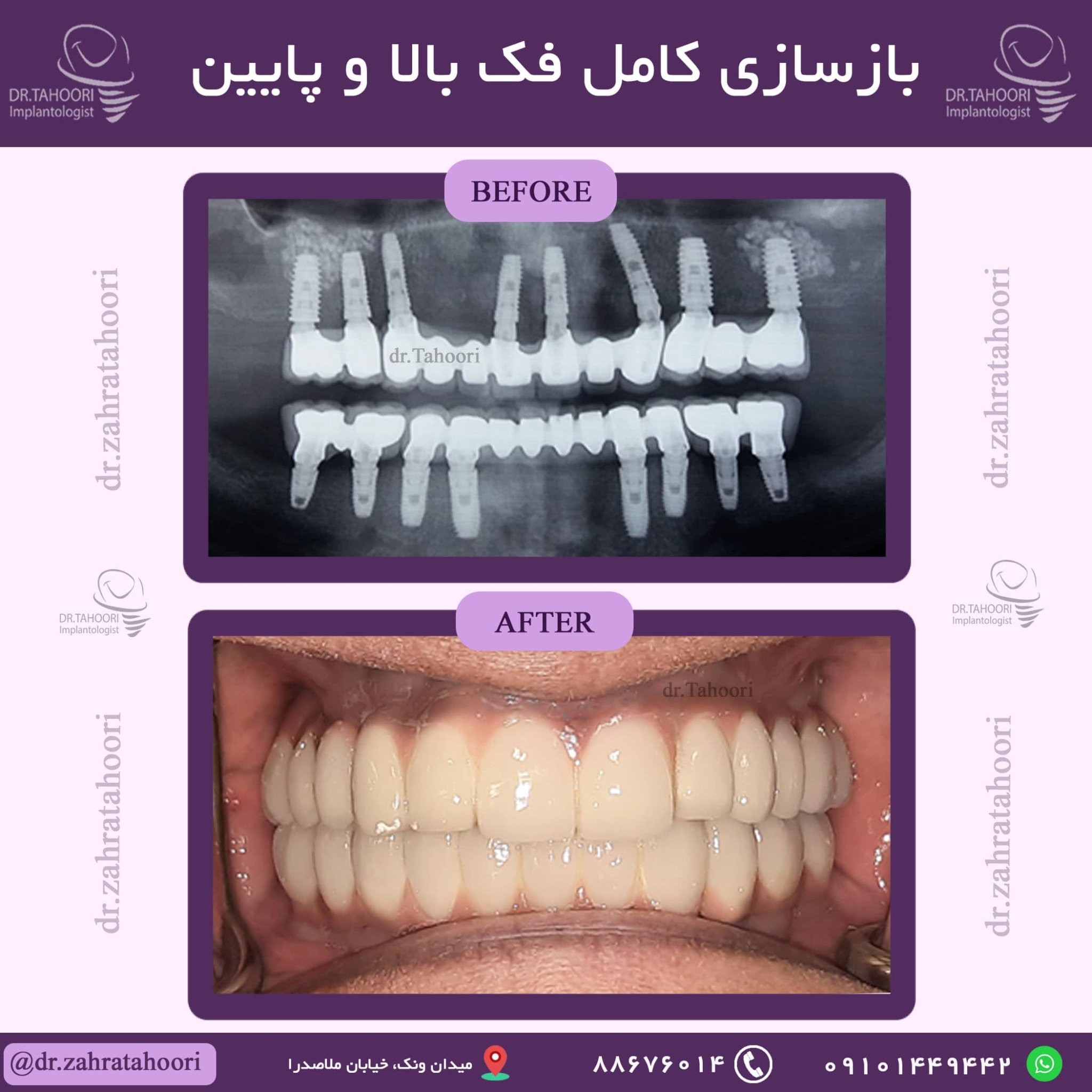 بازسازی فک بالا و پایین