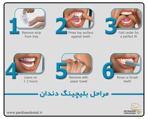روش انجام بلیچینگ دندان