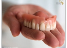 ایمپلنت بهتر است یا دندان مصنوعی؟