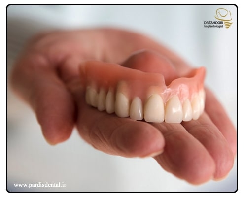 ایمپلنت بهتر است یا دندان مصنوعی؟