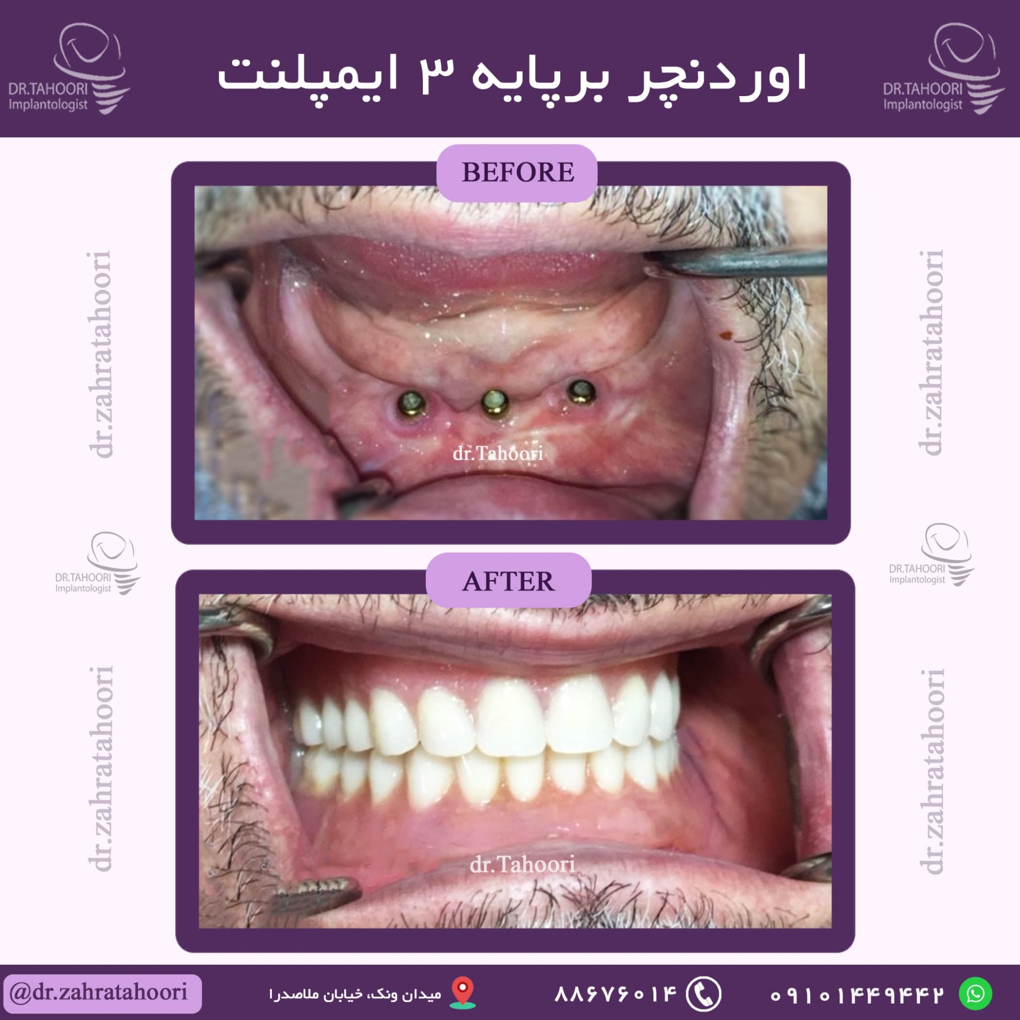 اوردنچر برپایه 3 ایمپلنت