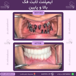 بازسازی دندان