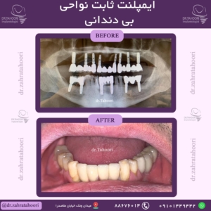 ایمپلنت ثابت نواحی بی دندان