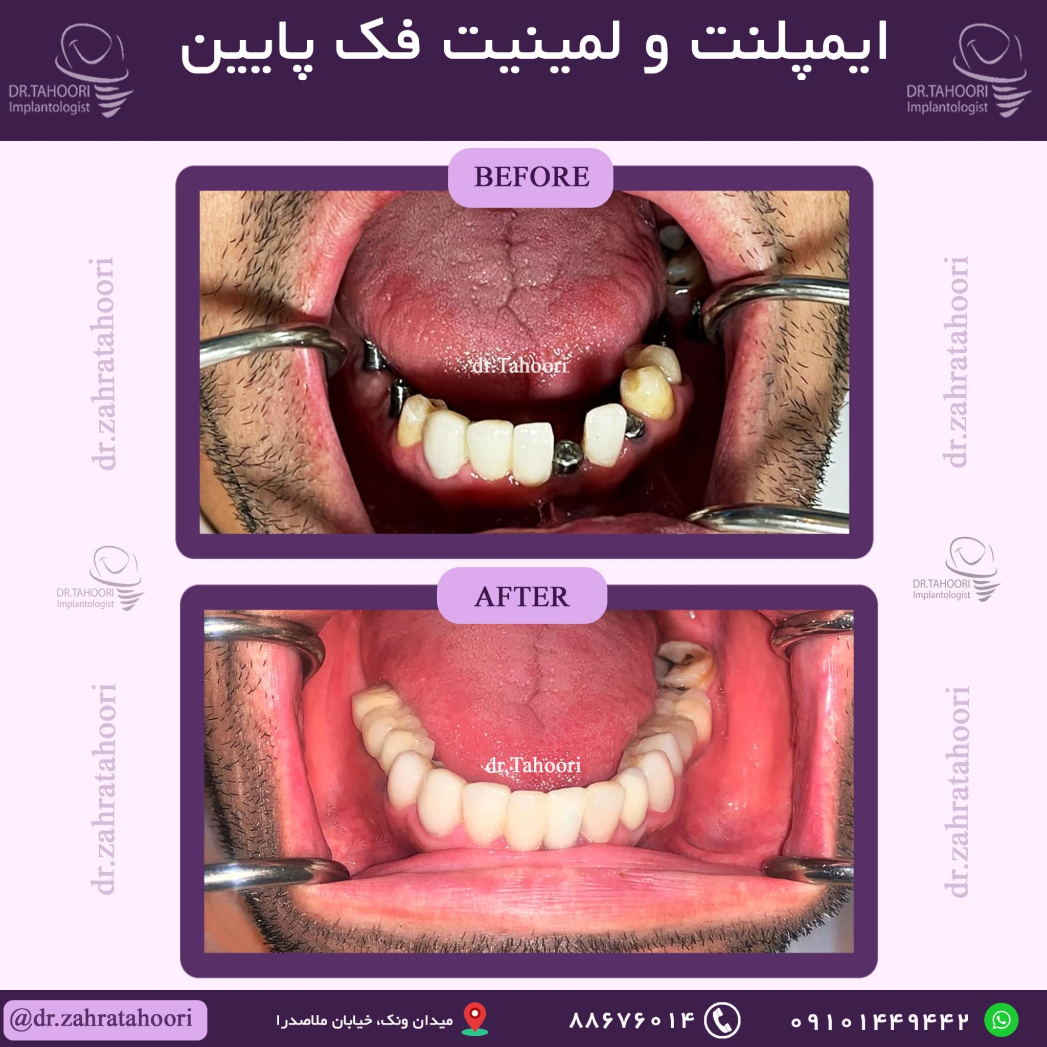 عکس لمینت دندان قبل و بعد