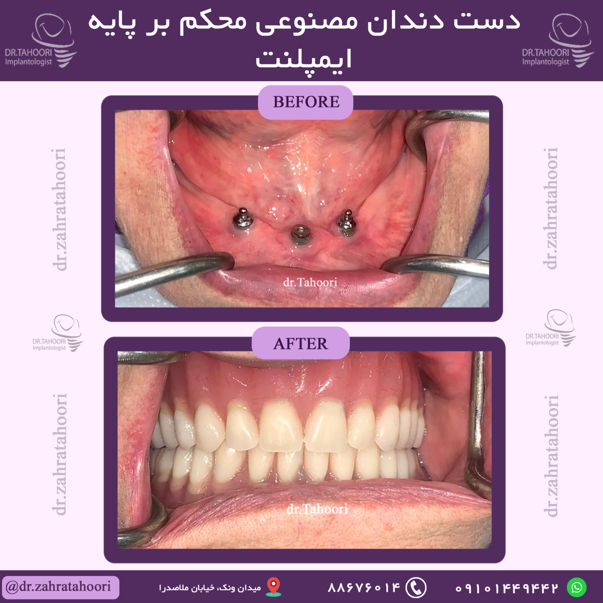 دندان مصنوعی بر پایه ایمپلنت